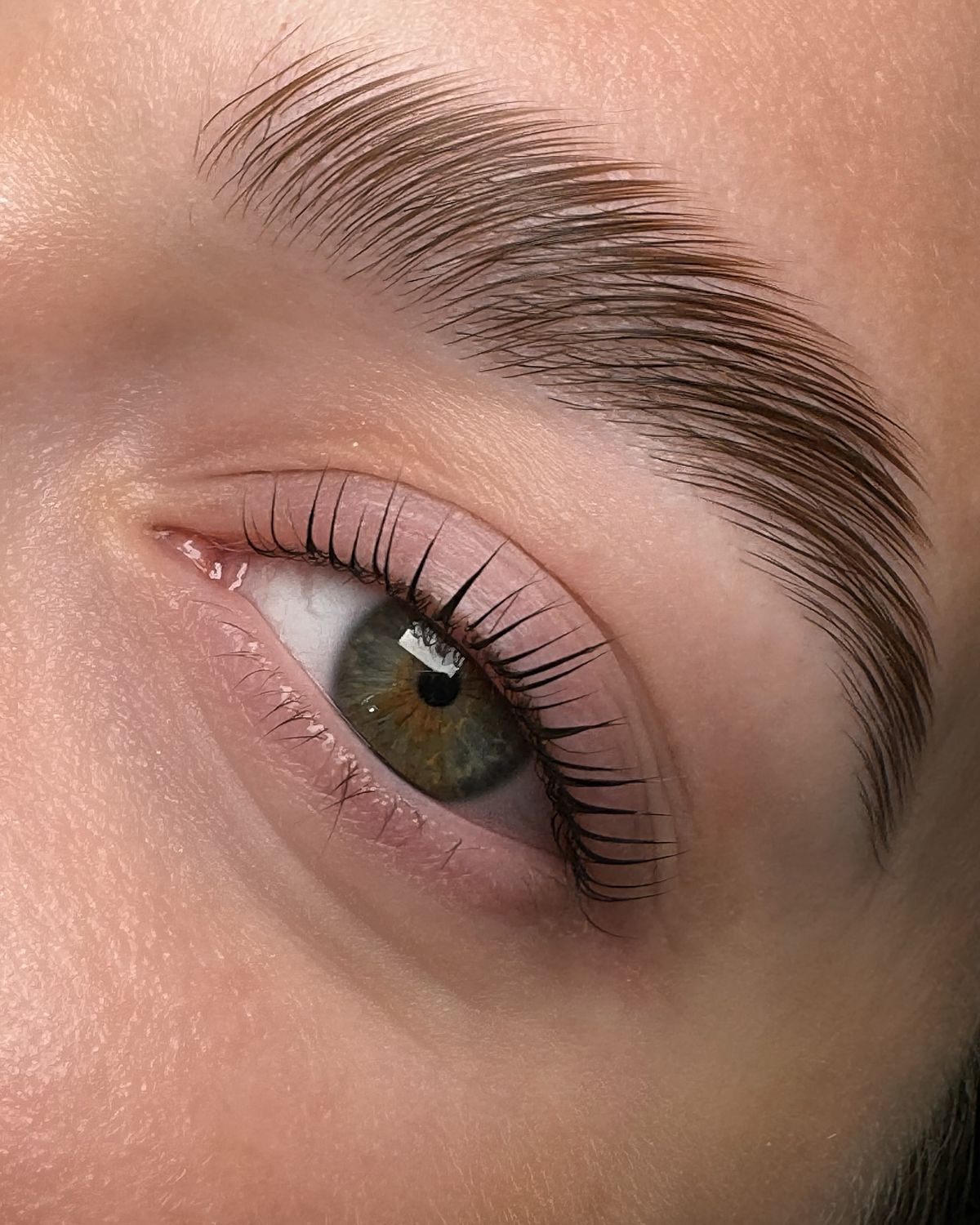 Brow Lift
